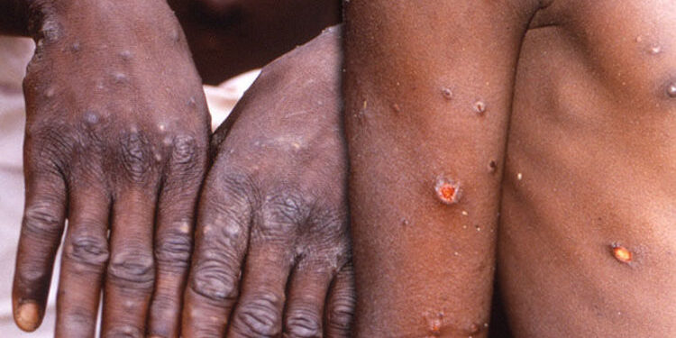 Monkey Pox: Ghana Health Service confirms 5 cases
