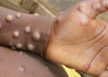 Monkeypox: South Africa reports first monkeypox case