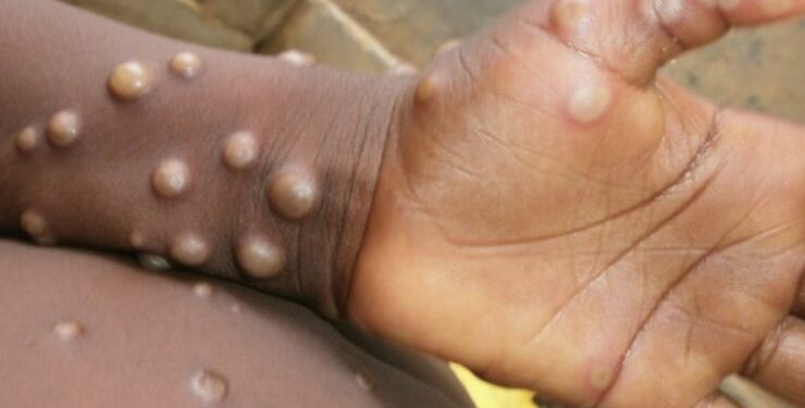 Monkeypox: South Africa reports first monkeypox case