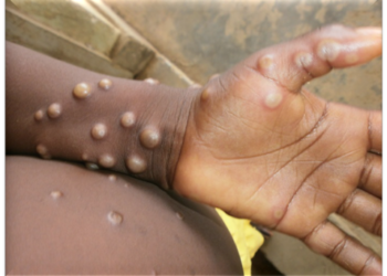 Monkeypox spreads sexually in the DR Congo, WHO says